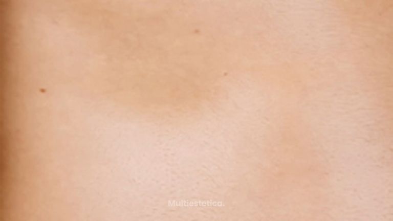 Ginecomastia - Clinica Dermatológica y Cirugía Estética Puebla