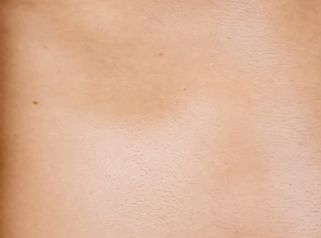 Ginecomastia - Clinica Dermatológica y Cirugía Estética Puebla