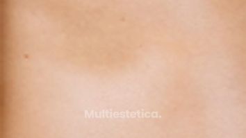 Ginecomastia - Clinica Dermatológica y Cirugía Estética Puebla