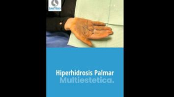 Hiperhidrosis