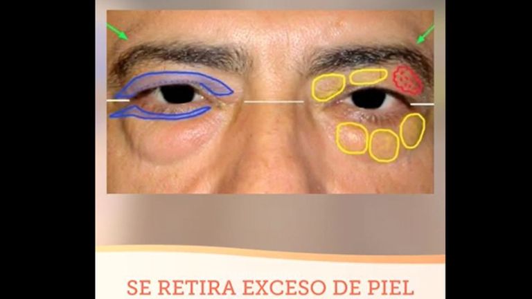 Blefaroplastia