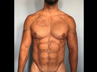 Marcación abdominal - Dr. Christian Augusto Morales Orozco
