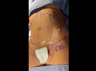 Liposucción - Dr. Xavier Sánchez García