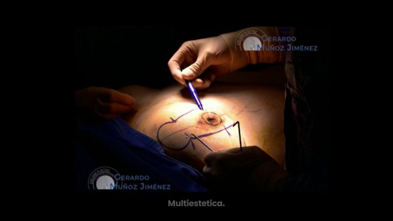 Mastopexia - Dr. Gerardo Muñoz Jiménez