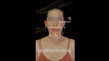 Frontoplastia - Dr. Franco Cravioto