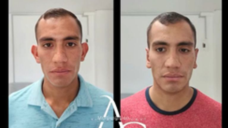 Otoplastia - Dr. Alejandro Cruz Segura