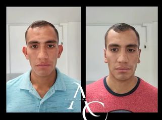 Otoplastia - Dr. Alejandro Cruz Segura