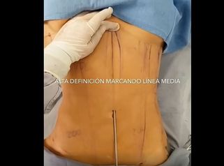 Alta definición Marcación abdominal