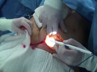 La mejor forma de acabar con la flacidez abdominal