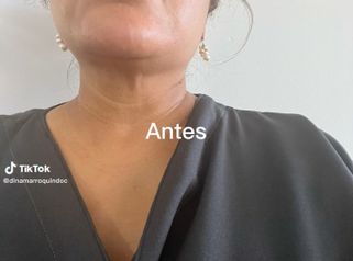 Hilos tensores - Joyas Clinique Spa