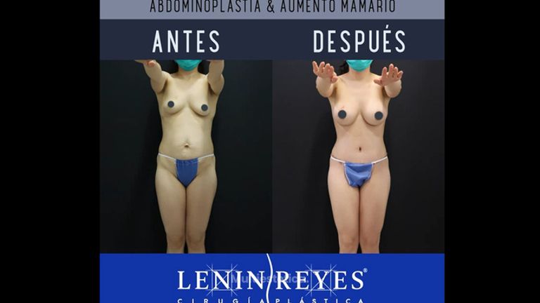 Abdominoplastia + Aumento de busto