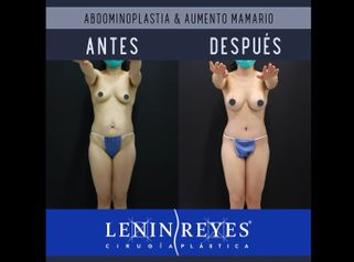 Abdominoplastia + Aumento de busto
