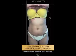 Abdominoplastia - Dr. Franco Cravioto
