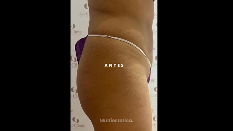 Relleno de glúteos - Dra. Elena Alvarez Velázquez