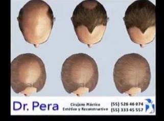 Acaba con la alopecia de la forma más eficaz