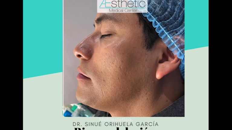 Rinomodelación - Dr. Sinué Orihuela García