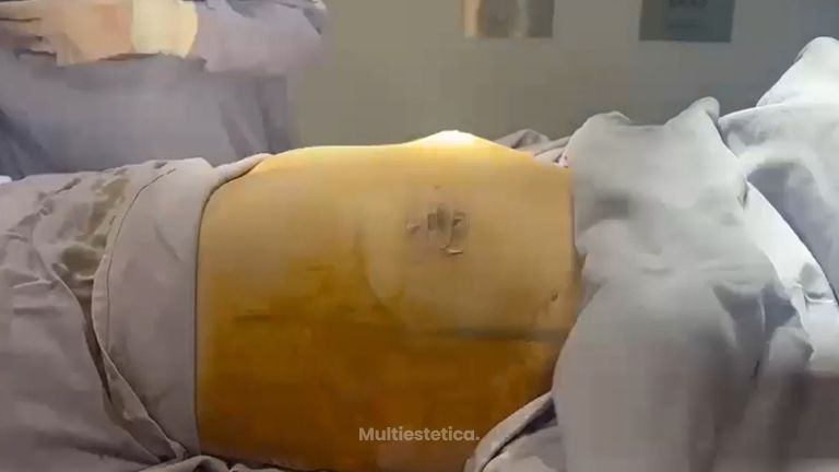 Aumento de busto - Dra. Amaya Ruvalcaba