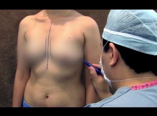 BREAST AUGMENTATION DR ROEL MOYEDA