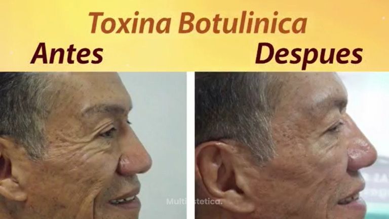 Toxina Botulinica