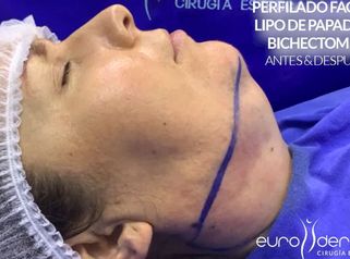 Cirugía de papada - Euroderma