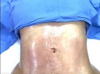 Marcaje Abdominal