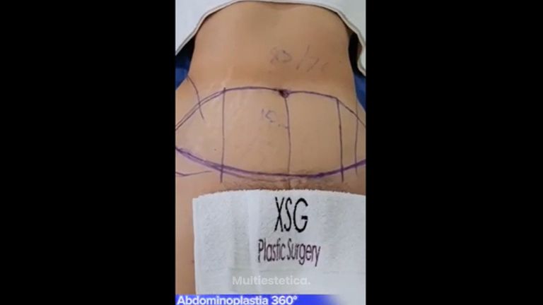 Abdominoplastia - Dr. Xavier Sánchez García