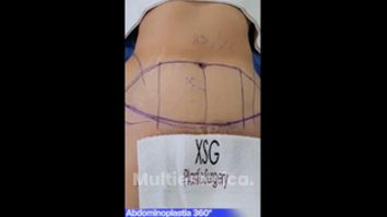 Abdominoplastia - Dr. Xavier Sánchez García