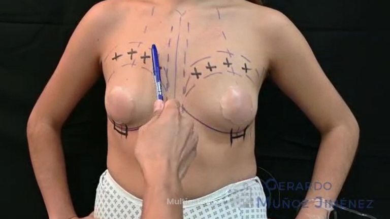 Aumento de busto - Dr. Gerardo Muñoz Jiménez