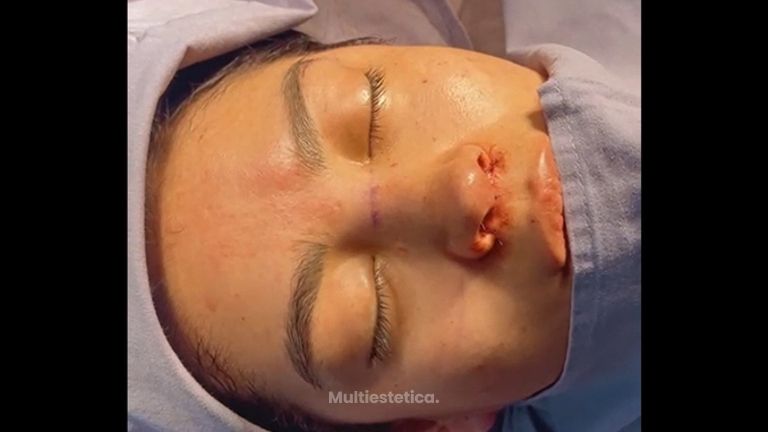 Rinoplastia - Dr. Christian Augusto Morales Orozco