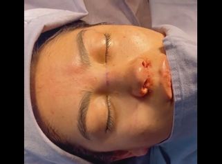 Rinoplastia - Dr. Christian Augusto Morales Orozco