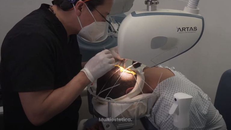 TRASPLANTE CAPILAR, CON ROBOT ARTAS, DR ALEJANDRO MÉNDEZ SASHIDA, LEÓN GTO, MÉXICO. 1080p