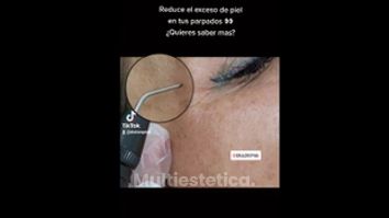 Blefaroplastia sin cirugía - B+ Care. Dra.Lore Piña