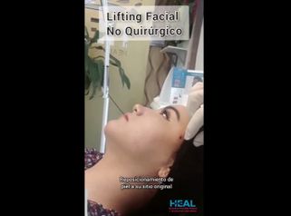 Lifting no quirúrgico - Clínica Heal Aesthetics