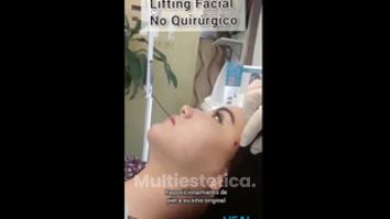 Lifting no quirúrgico - Clínica Heal Aesthetics