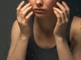 Cicatrices de acné - Clinica Dermatológica y Cirugía Estética Puebla