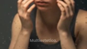 Cicatrices de acné - Clinica Dermatológica y Cirugía Estética Puebla