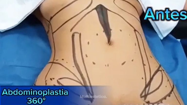 Abdominoplastia - Dr. Xavier Sánchez García