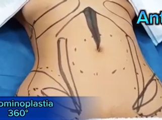 Abdominoplastia - Dr. Xavier Sánchez García