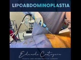 Lipoabdominoplastia - Dr. Eduardo Cartagena
