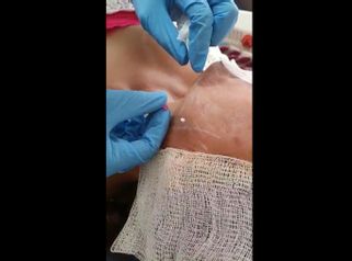 Hilos tensores faciales - Unidad de Medicina Estética de Querétaro
