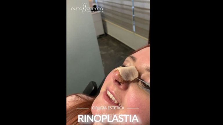 Rinoplastia - Euroderma