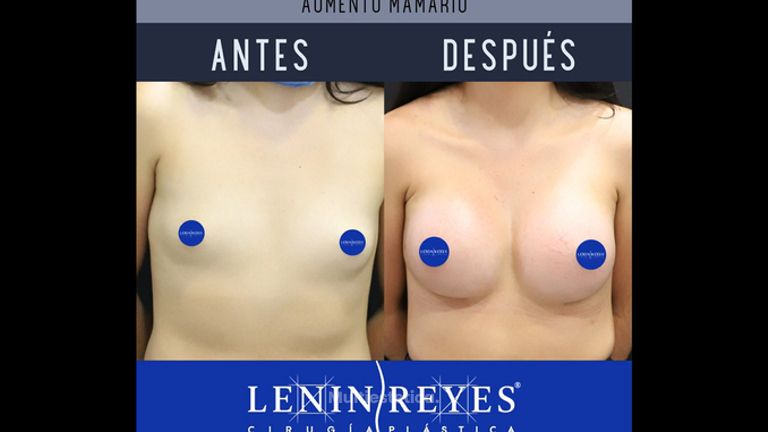 Aumento de busto - Dr. Lenin Alfonso Reyes Ibarra
