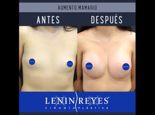 Aumento de busto - Dr. Lenin Alfonso Reyes Ibarra