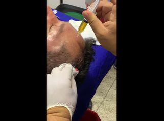 PRP - Dr. Jesús Omar Carreón Terrones