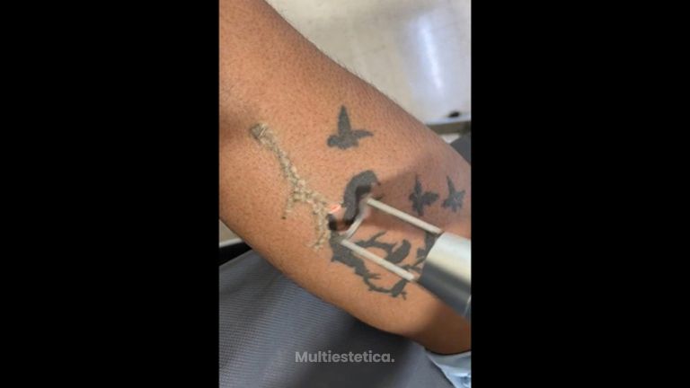 Eliminación de tatuajes - Dr. Raymundo Alfredo Sánchez Martínez