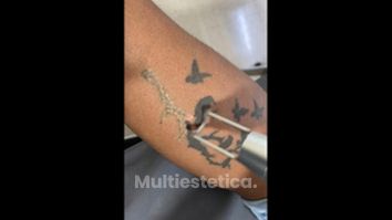 Eliminación de tatuajes - Dr. Raymundo Alfredo Sánchez Martínez