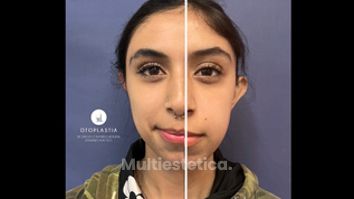 Otoplastia - Dr. Sergio Guillermo Ramírez Ledesma