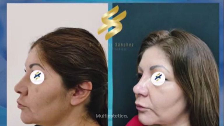 Rinoplastia