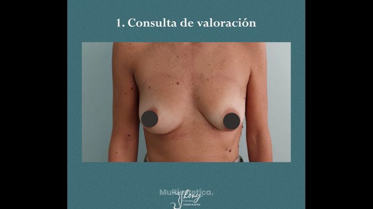 Mastopexia - Dr. Jhony Camarero