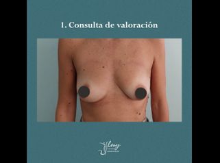 Mastopexia - Dr. Jhony Camarero